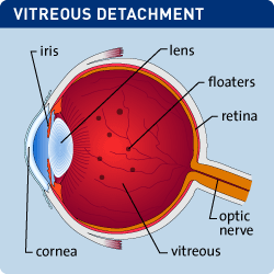 vitreous-detachment-250x250